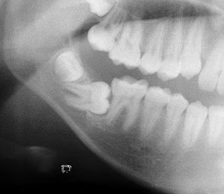 impacted molars impaction